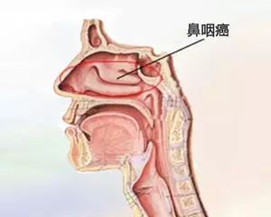 南方人鼻咽癌高发原因解析